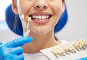 Sublimez votre sourire grâce aux facettes